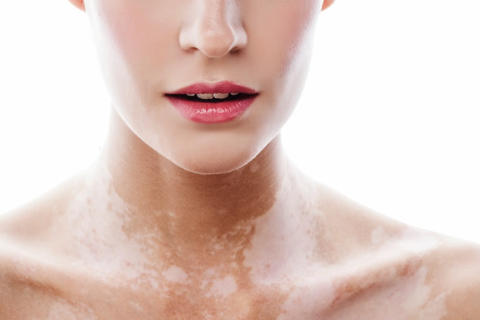  A example of vitiligo